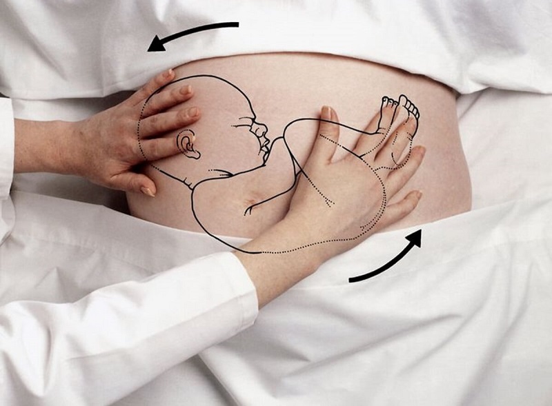 Hình ảnh mô tả hỗ trợ sinh bằng giác hút